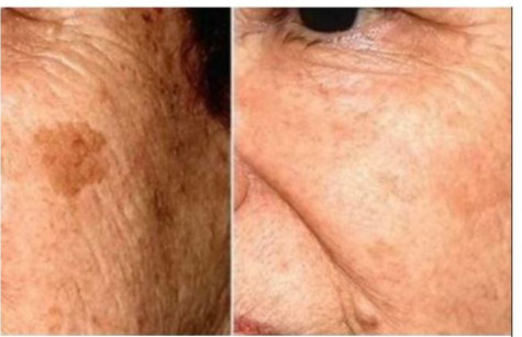 POZNATI DERMATOLOG OTKRIO: Ovo je uloga sode bikarbone u liječenju mrlja na licu! - featured image