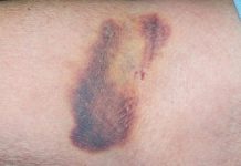 DOBRO JE ZNATI: Efikasno i prirodno uklonite MODRICE za samo 24 sata